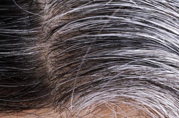 Know The Causes Of White Hair And Easy Ways To Prevent It Naturally